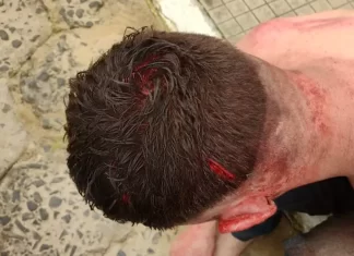 Homem é agredido com golpes de pá no Buraco Quente em Araranguá