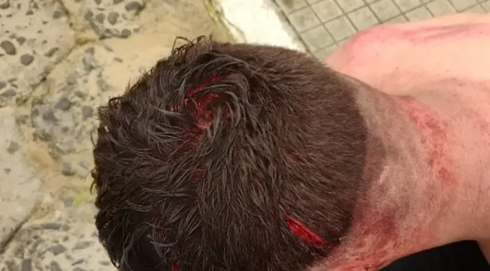 Homem é agredido com golpes de pá no Buraco Quente em Araranguá